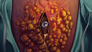 Cyst still 3